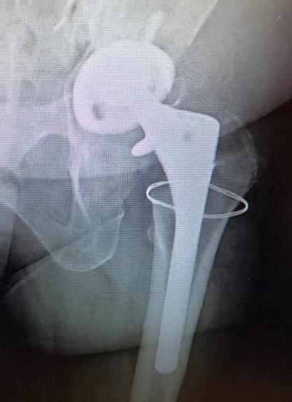 Zimmer Versys Total Hip Prosthesis (Implant 180220)